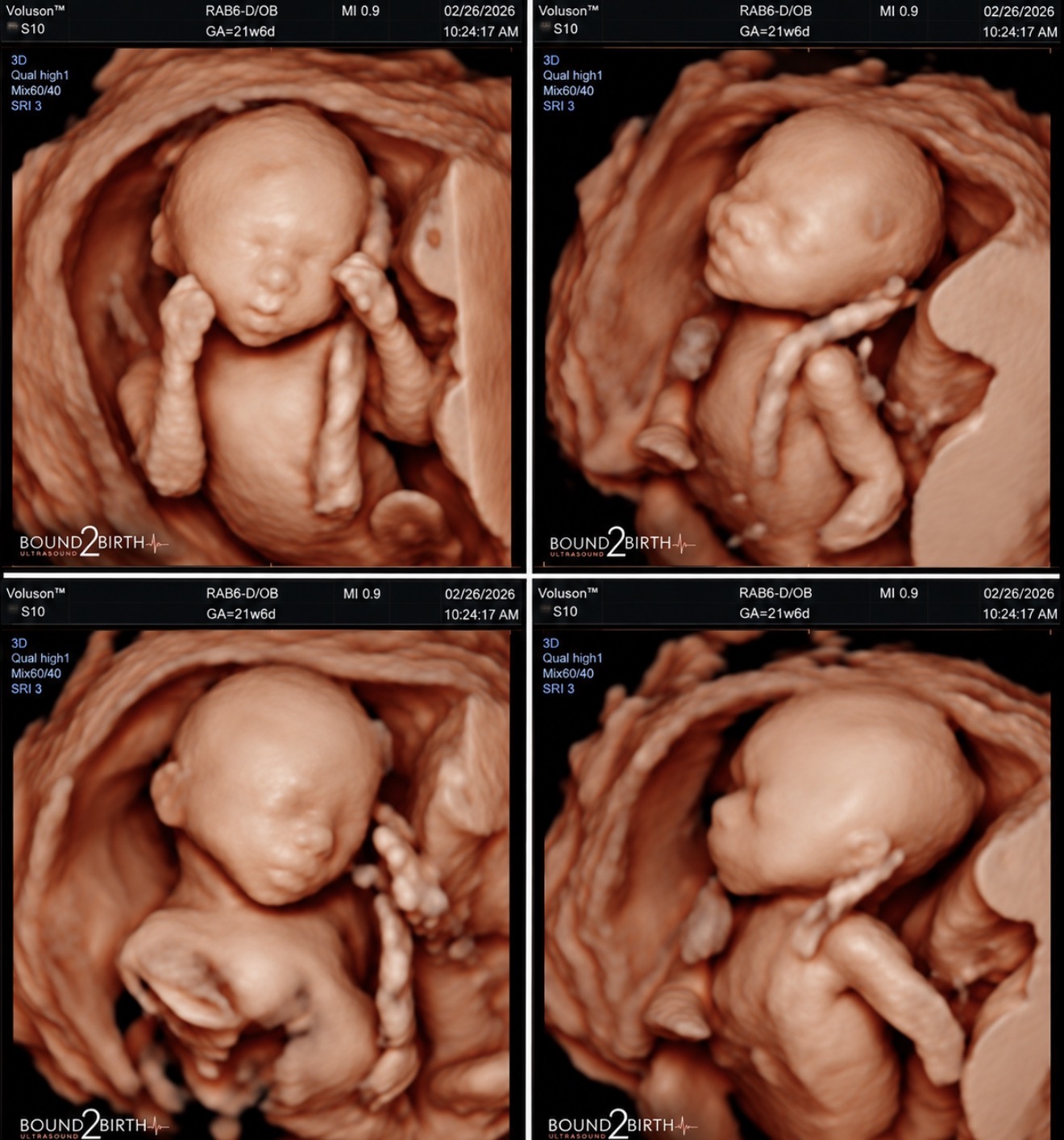 Four supplied three-dimensional ultrasound views